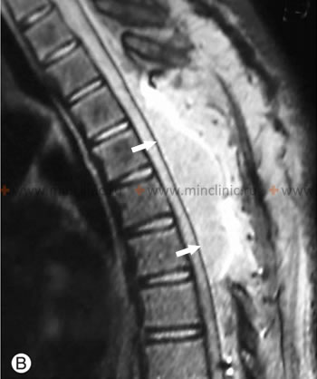 Extradural hematoma on MRI of the spine that arose in a patient after an operation to remove a hemangioma.